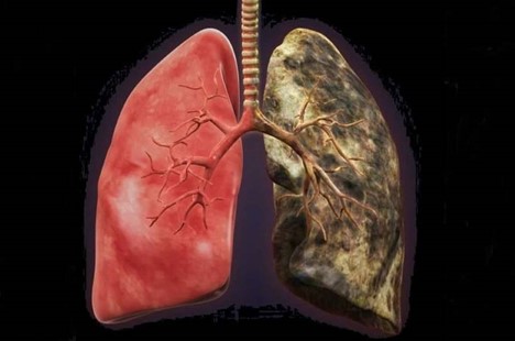 ریه های آلوده شده بابت آلودگی هوا